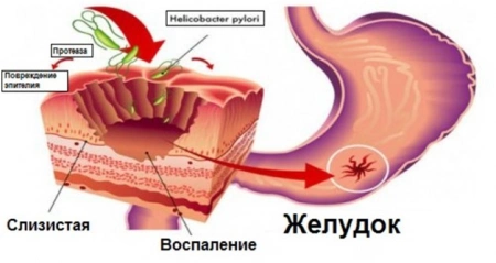 Бактерия хеликобактер: методы диагностики хеликобактерной инфекции